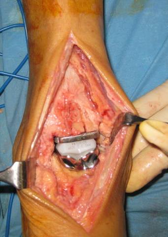 Operationsbild einer implantierten Sprunggelenkstotalprothese Typ Mobility